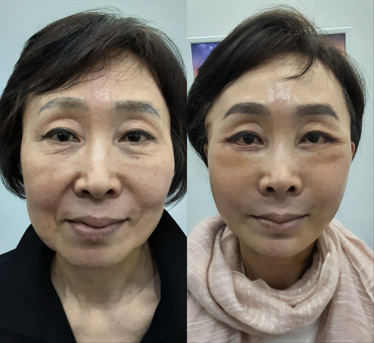Facelift before and after results at Seoul Miz Hospital (서울미즈병원), facial rejuvenation