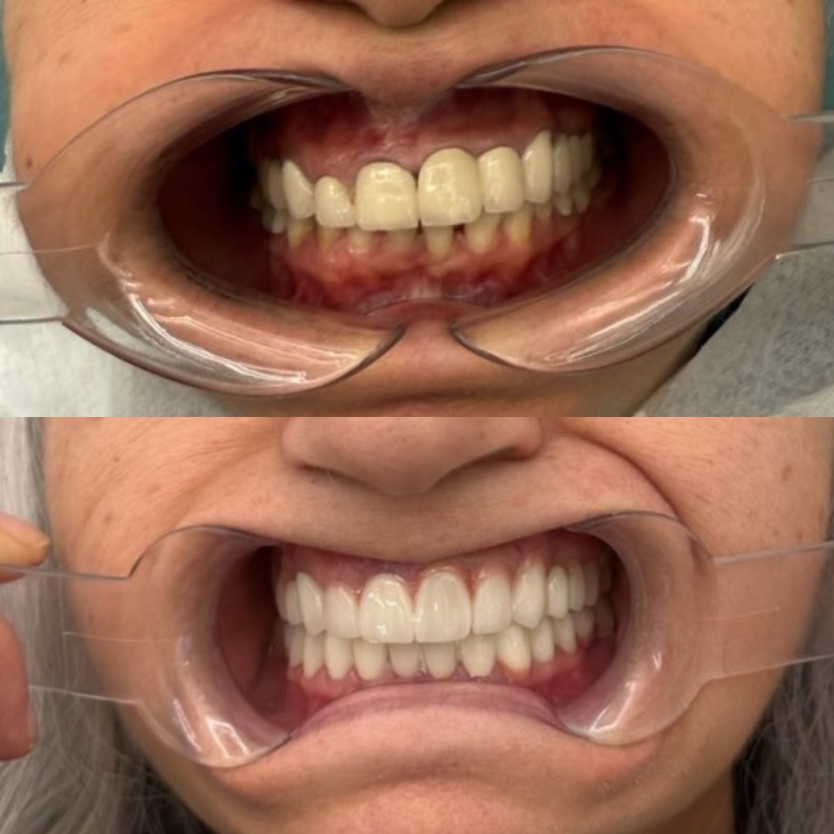 Before and after zirconia crown installation at KLİNİKEN – smile makeover results