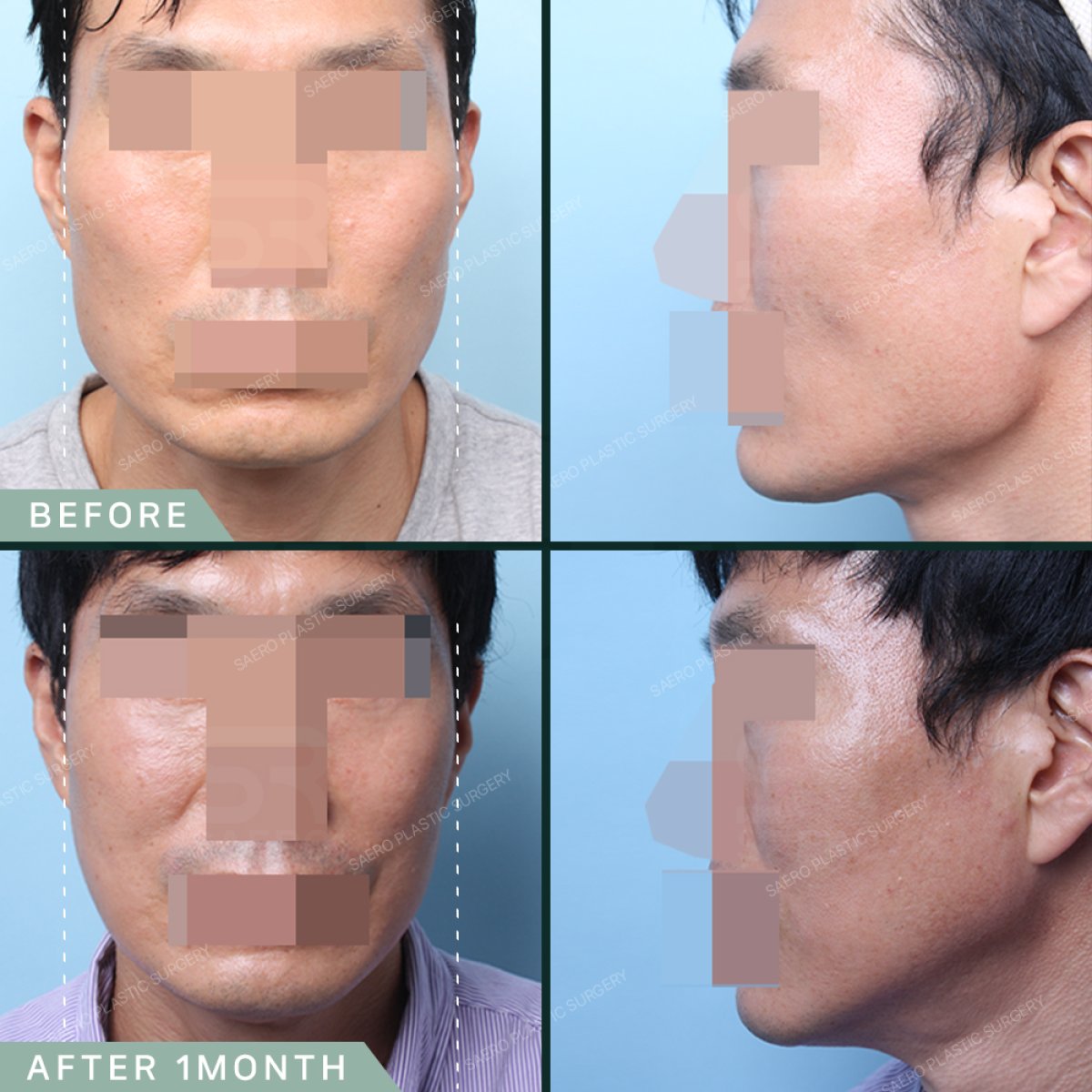 Before and after face contouring results at SAERO Plastic Surgery, improved jawline shape