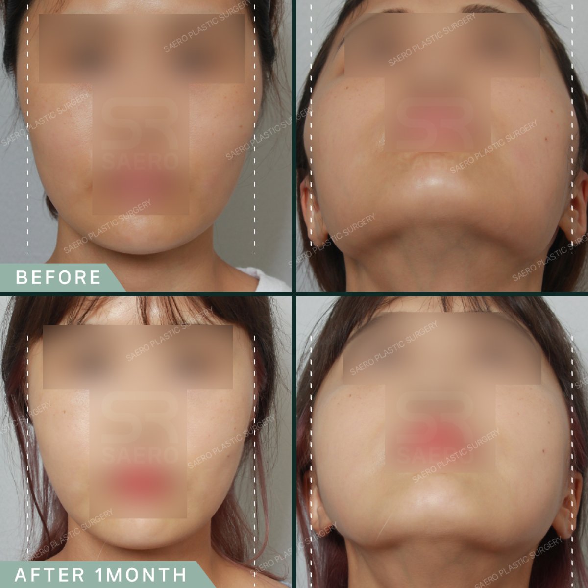 Результаты контурирования лица до и после в SAERO Plastic Surgery, улучшение линии челюсти