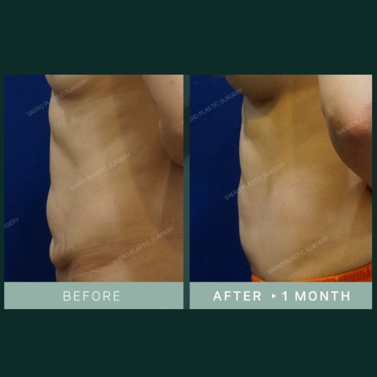 Результаты абдоминопластики до и после в SAERO Plastic Surgery, плоский живот через месяц