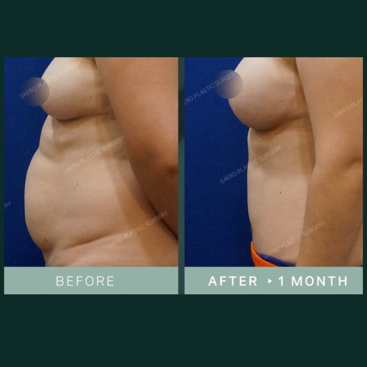 Результаты абдоминопластики в SAERO Plastic Surgery – плоский живот через 1 месяц