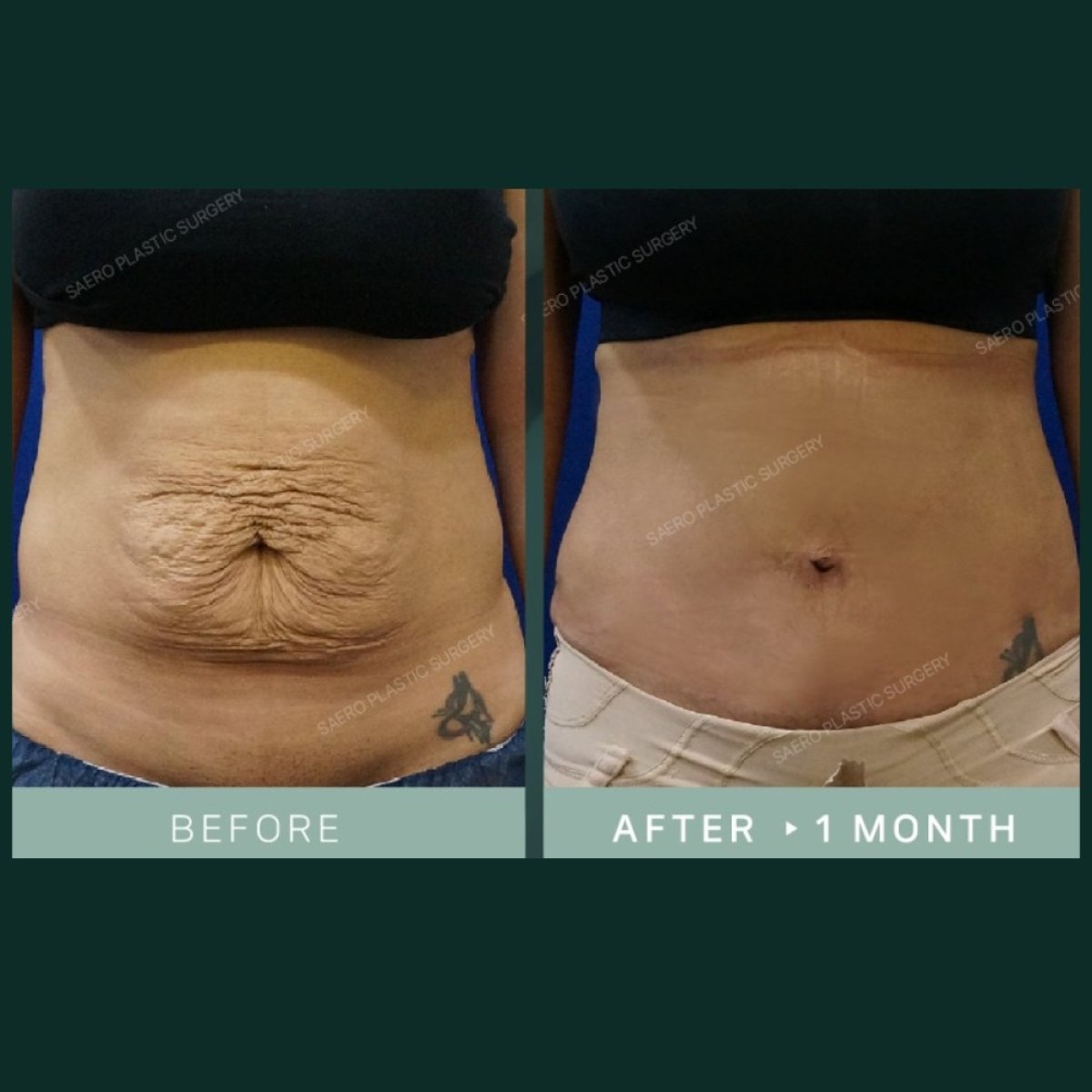 Vorher-nachher-Ergebnis Bauchdeckenstraffung bei SAERO Plastic Surgery – flacher Bauch nach 1 Monat