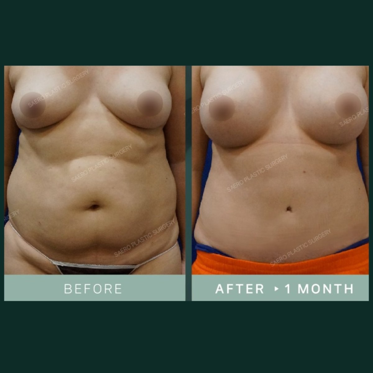 Before and after tummy tuck and liposuction results at SAERO Plastic Surgery, flatter abdomen