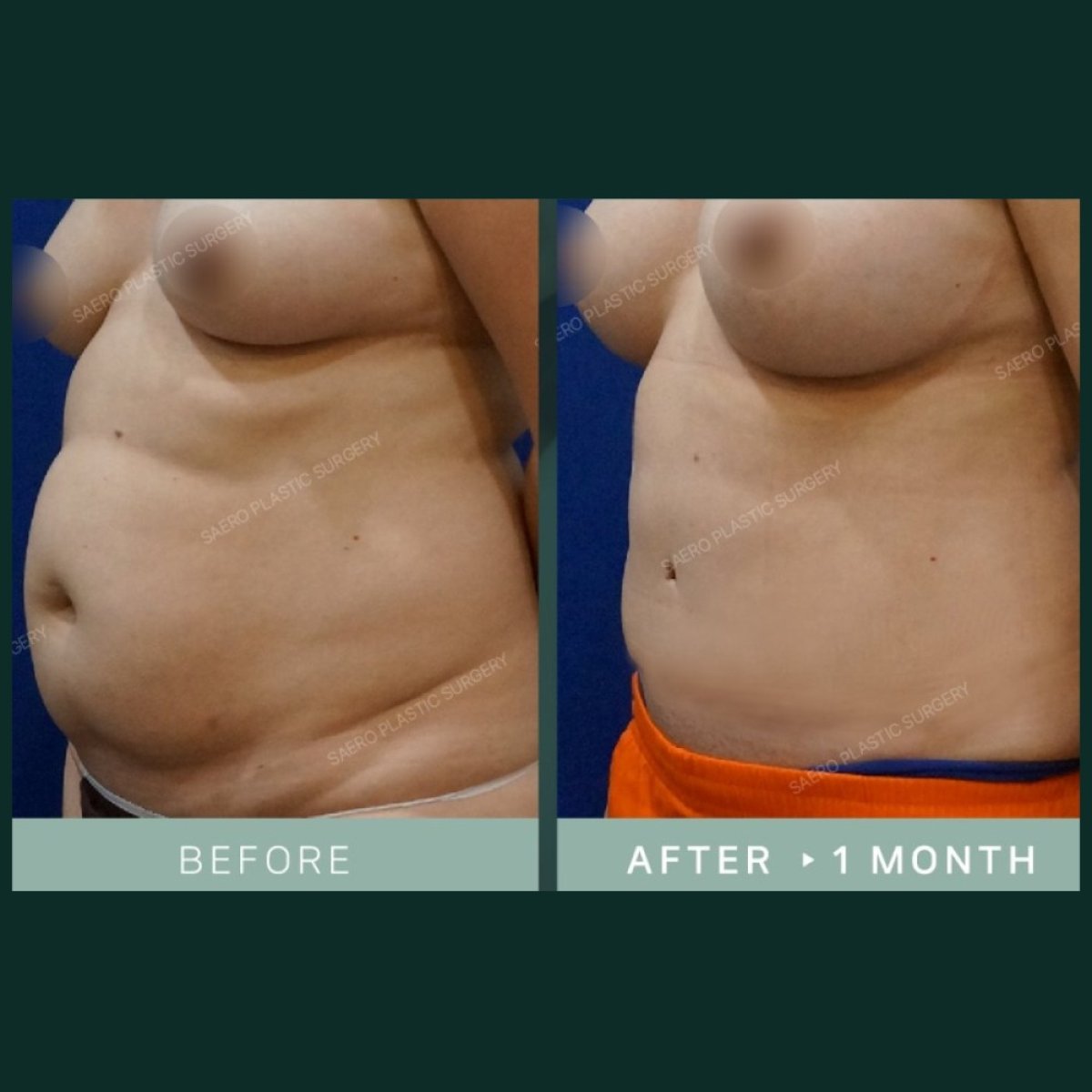 Before and after tummy tuck and liposuction results at SAERO Plastic Surgery, flatter abdomen