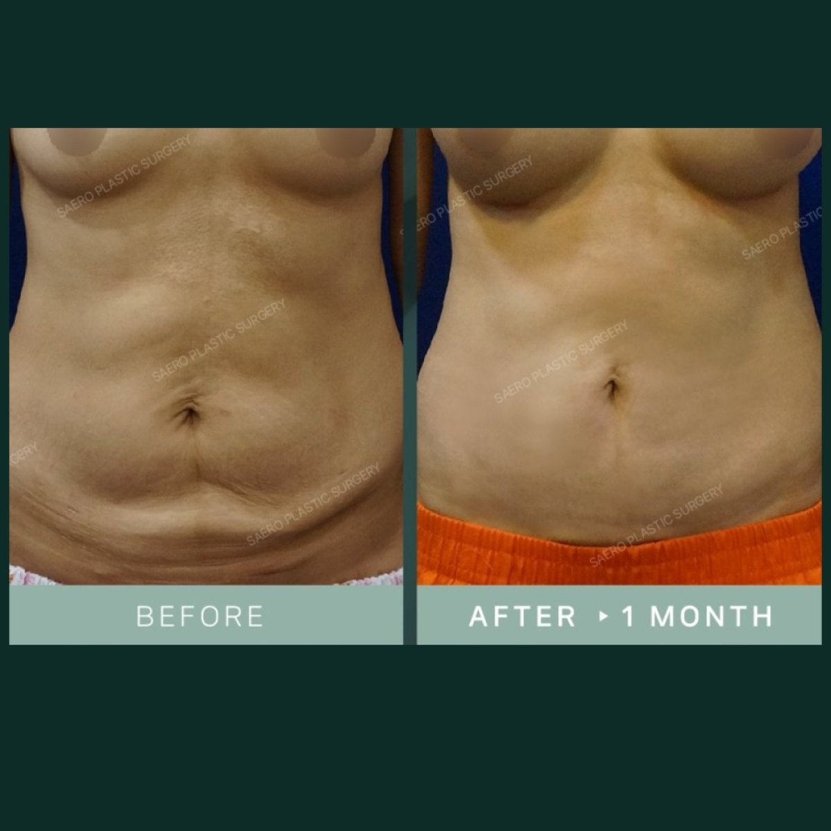 نتائج شد البطن وشفط الدهون في SAERO Plastic Surgery بعد شهر واحد من الجراحة