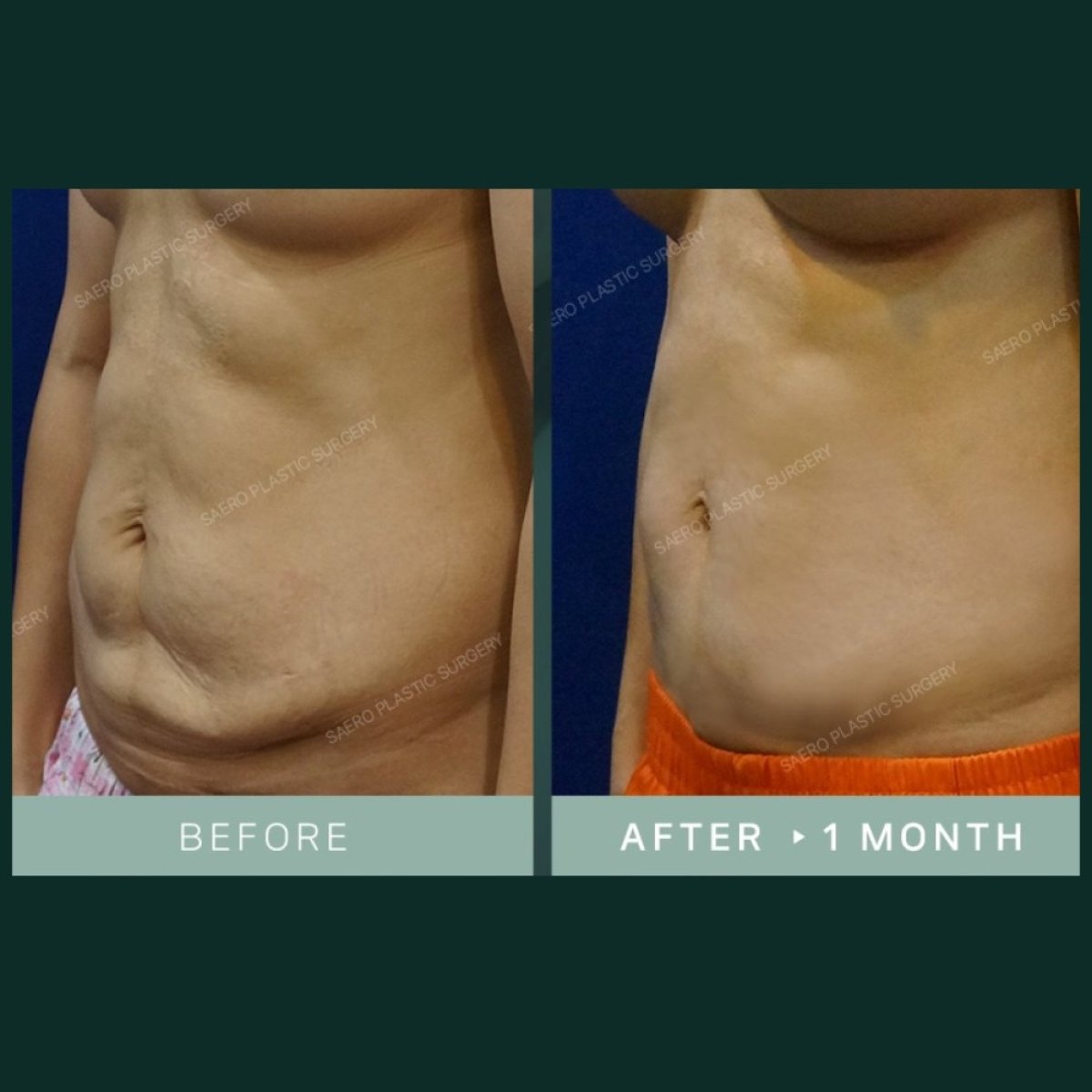Результаты абдоминопластики до и после в SAERO Plastic Surgery, плоский живот через месяц