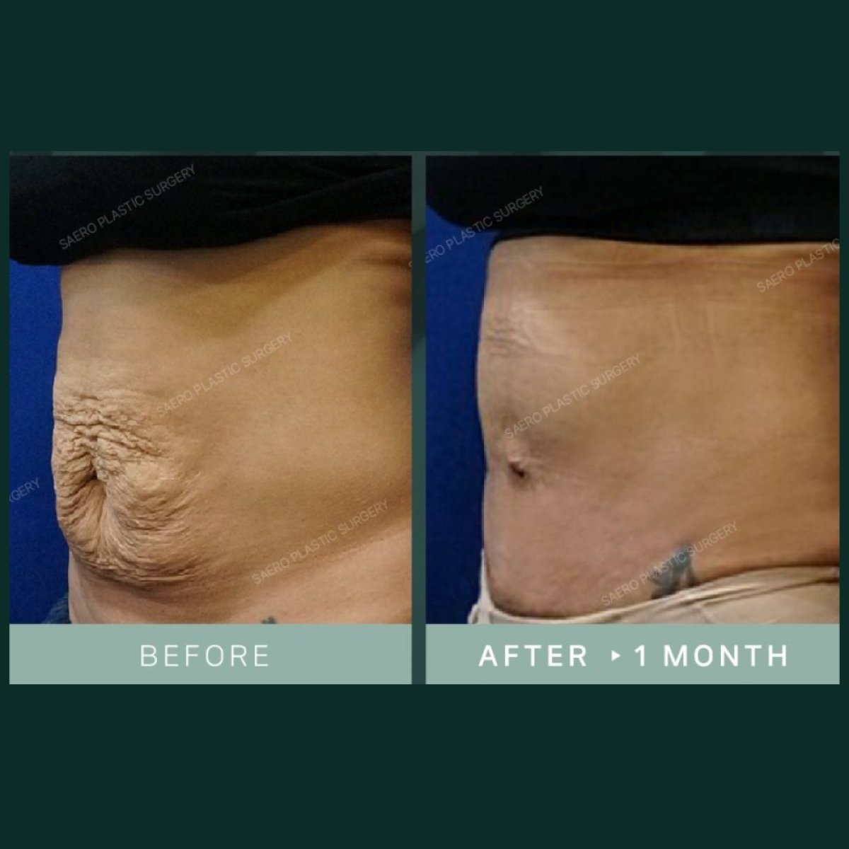 Before and after tummy tuck results at SAERO Plastic Surgery, smoother abdomen after 1 month
