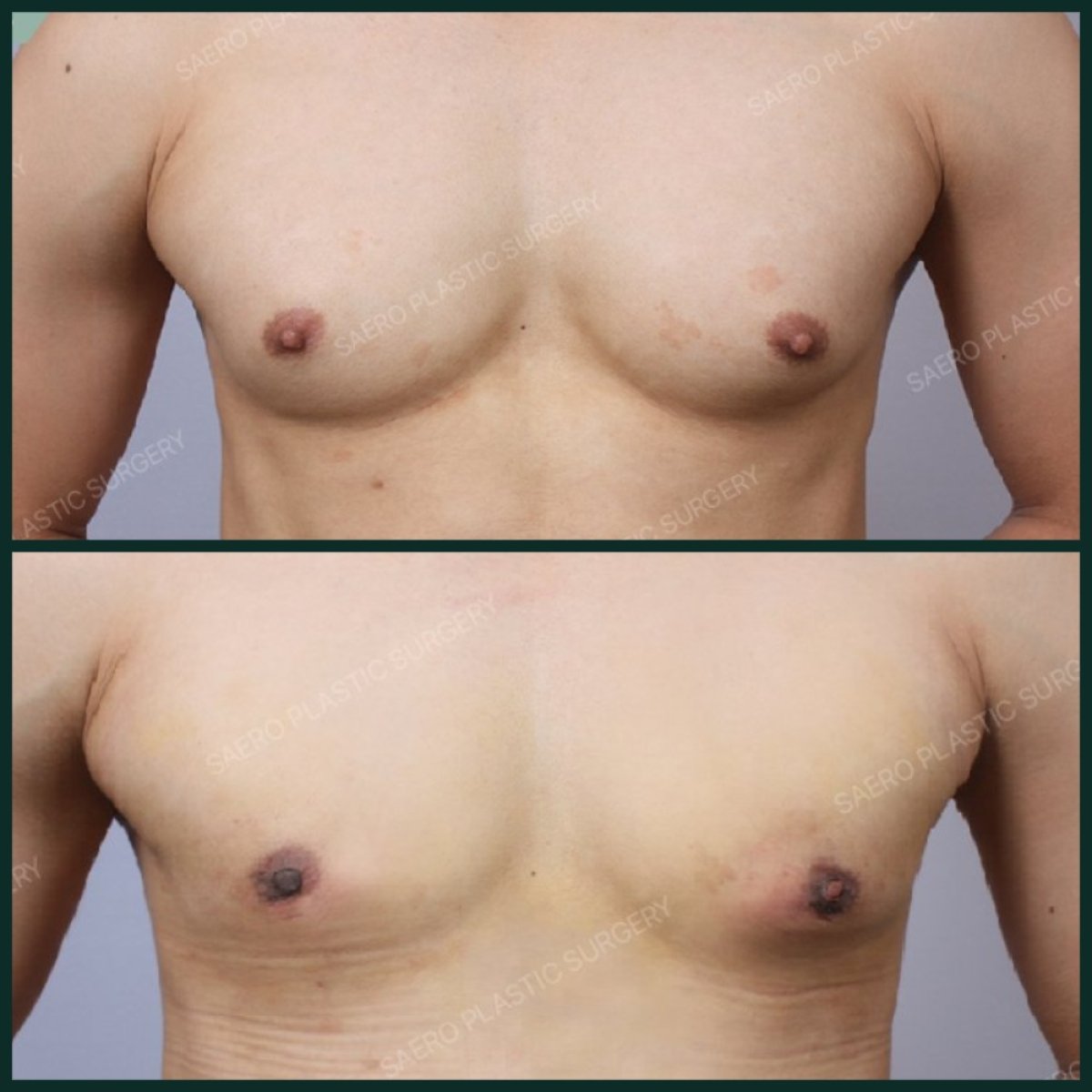 Résultats avant et après chirurgie gynécomastie chez SAERO Plastic Surgery, remodelage du torse