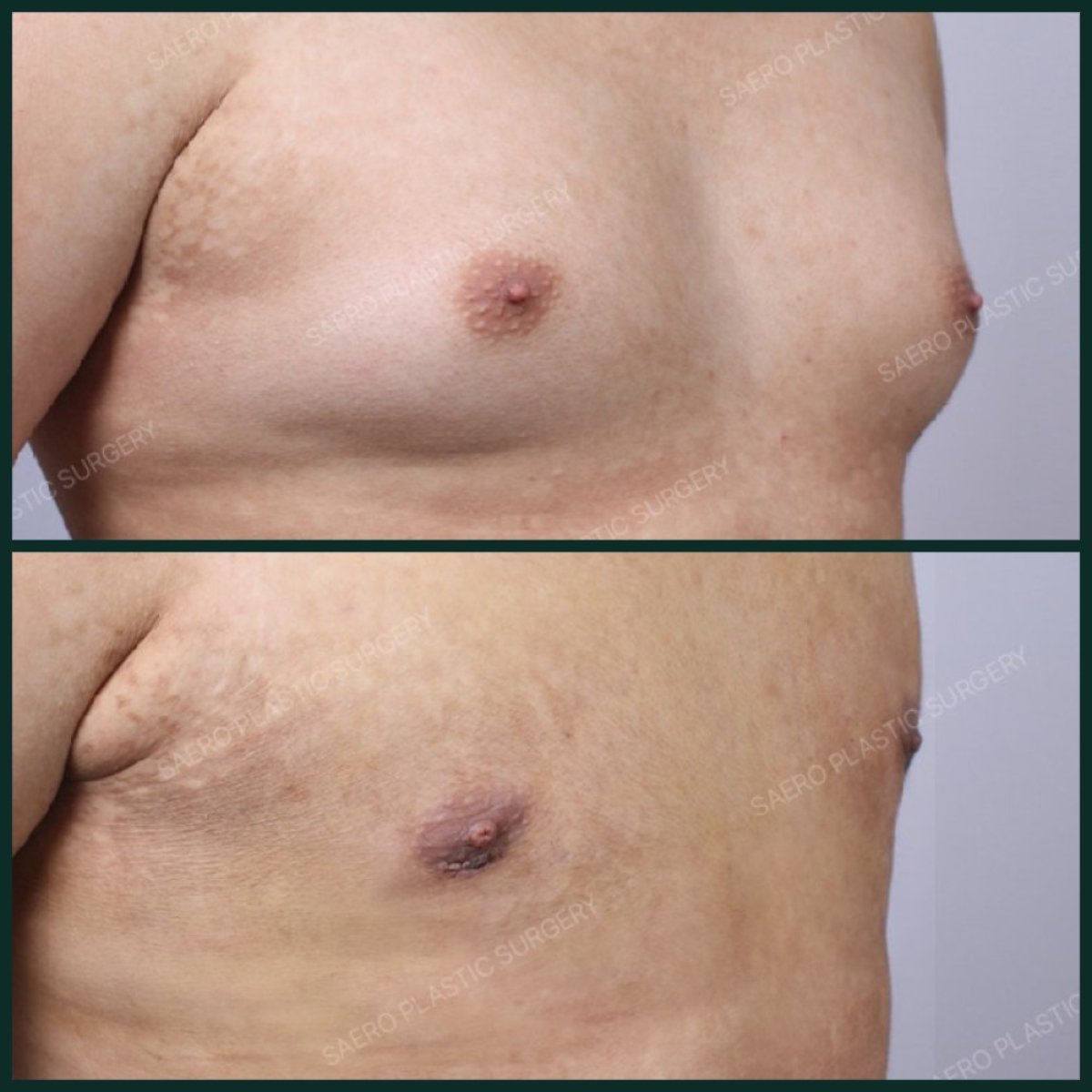 Résultats avant et après gynécomastie chez SAERO Plastic Surgery, remodelage du torse masculin