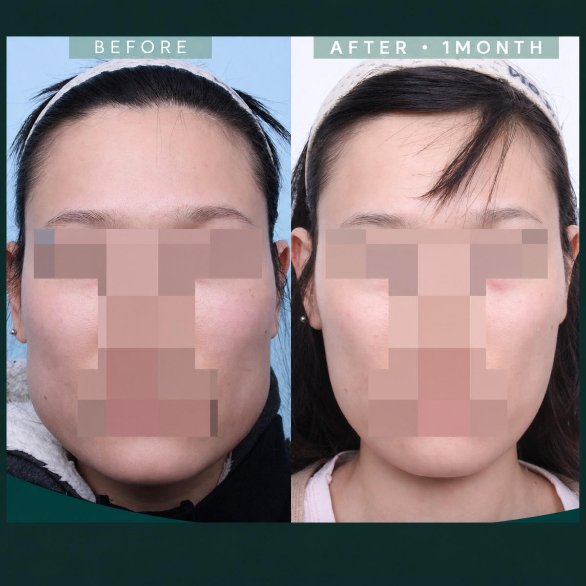 Результаты контурирования лица до и после в SAERO Plastic Surgery, более узкая линия челюсти