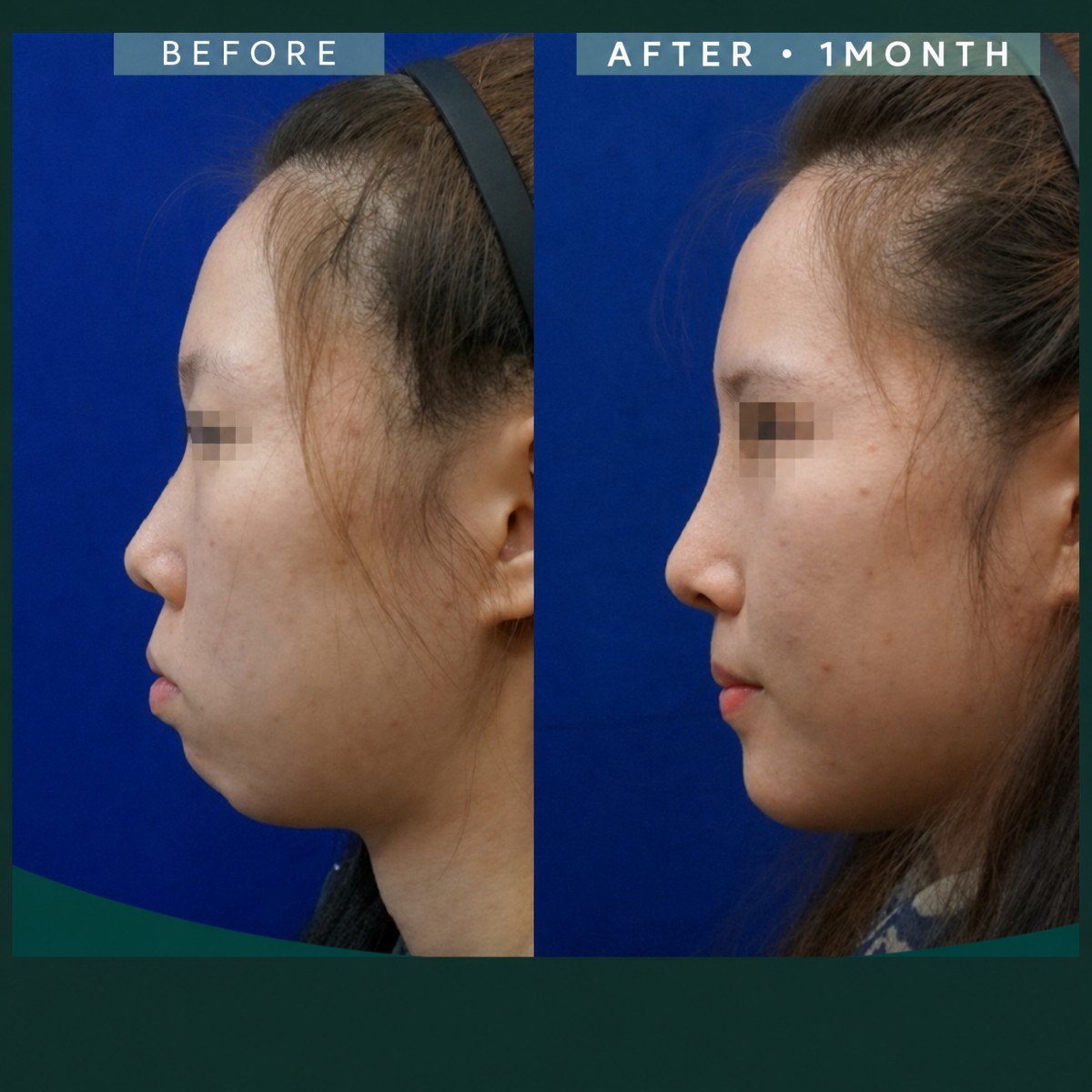 Результаты контурирования лица до и после в SAERO Plastic Surgery, улучшенный профиль челюсти