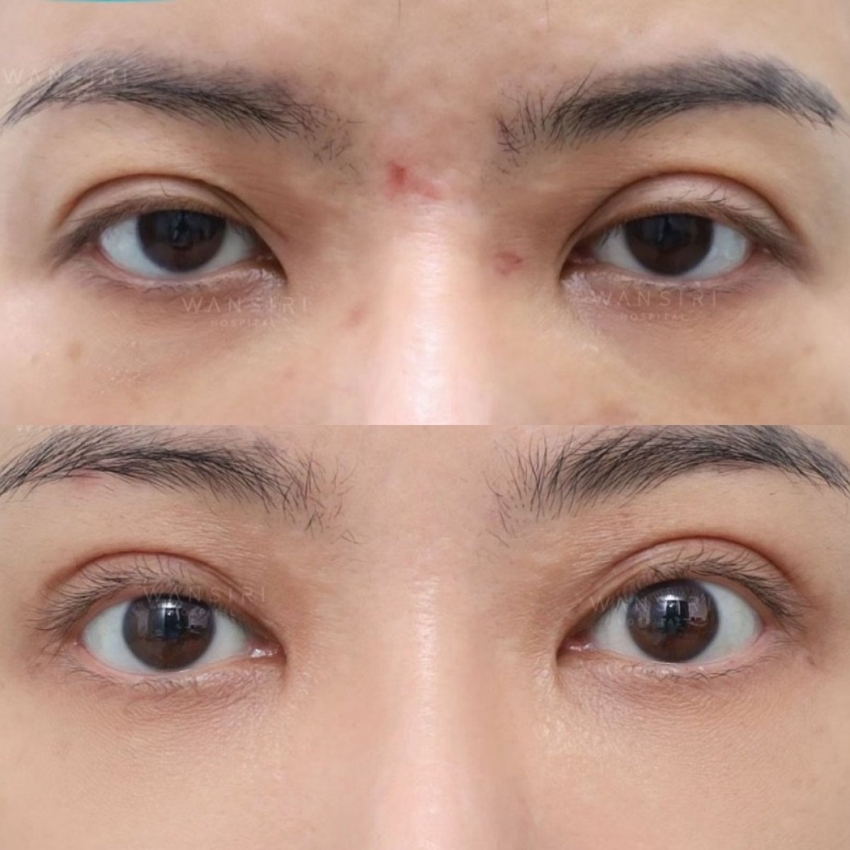 Before and after droopy eyelid surgery results at Wansiri Hospital, improved eyelid appearance