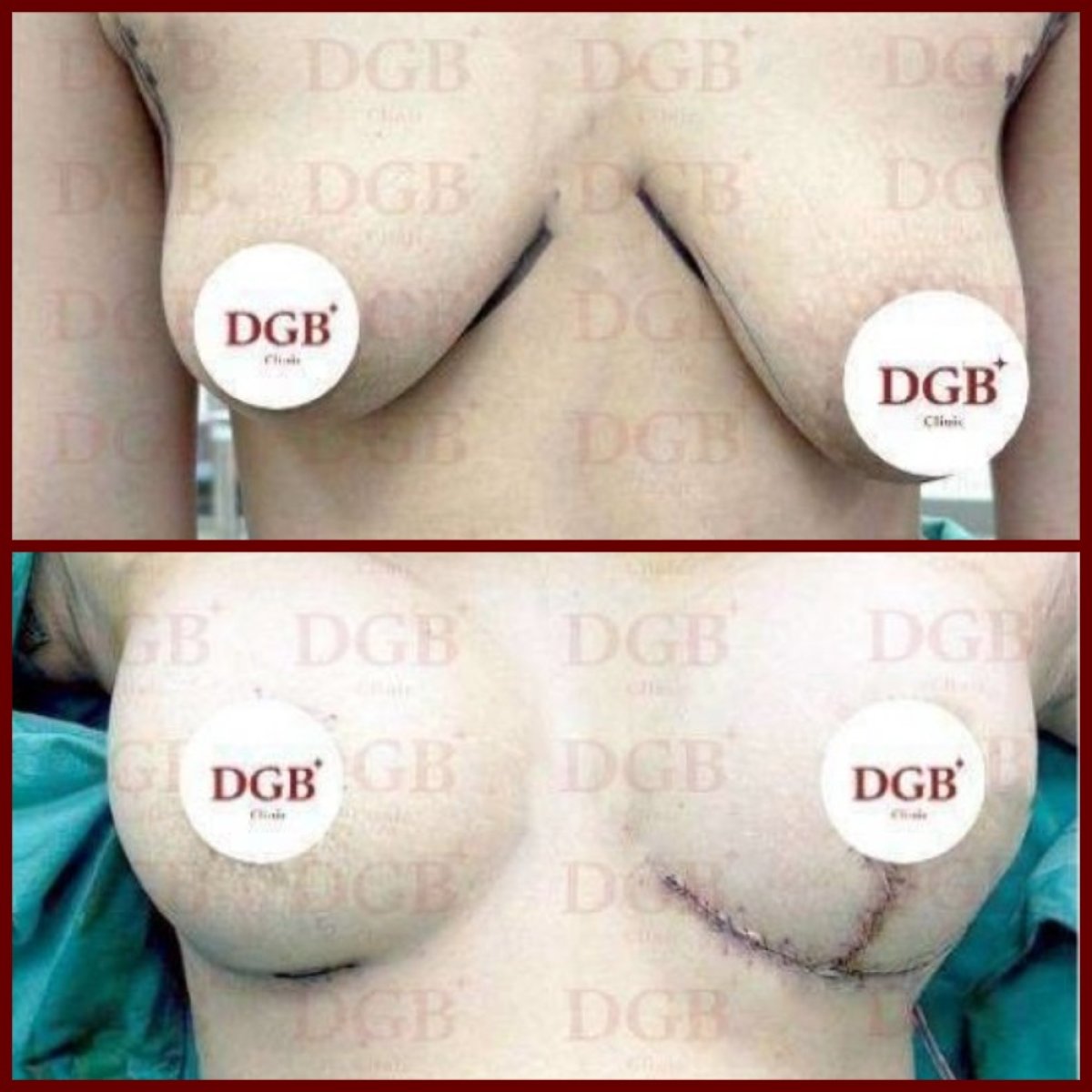 Before and after breast lift results at DGB Clinic – improved breast shape and contour