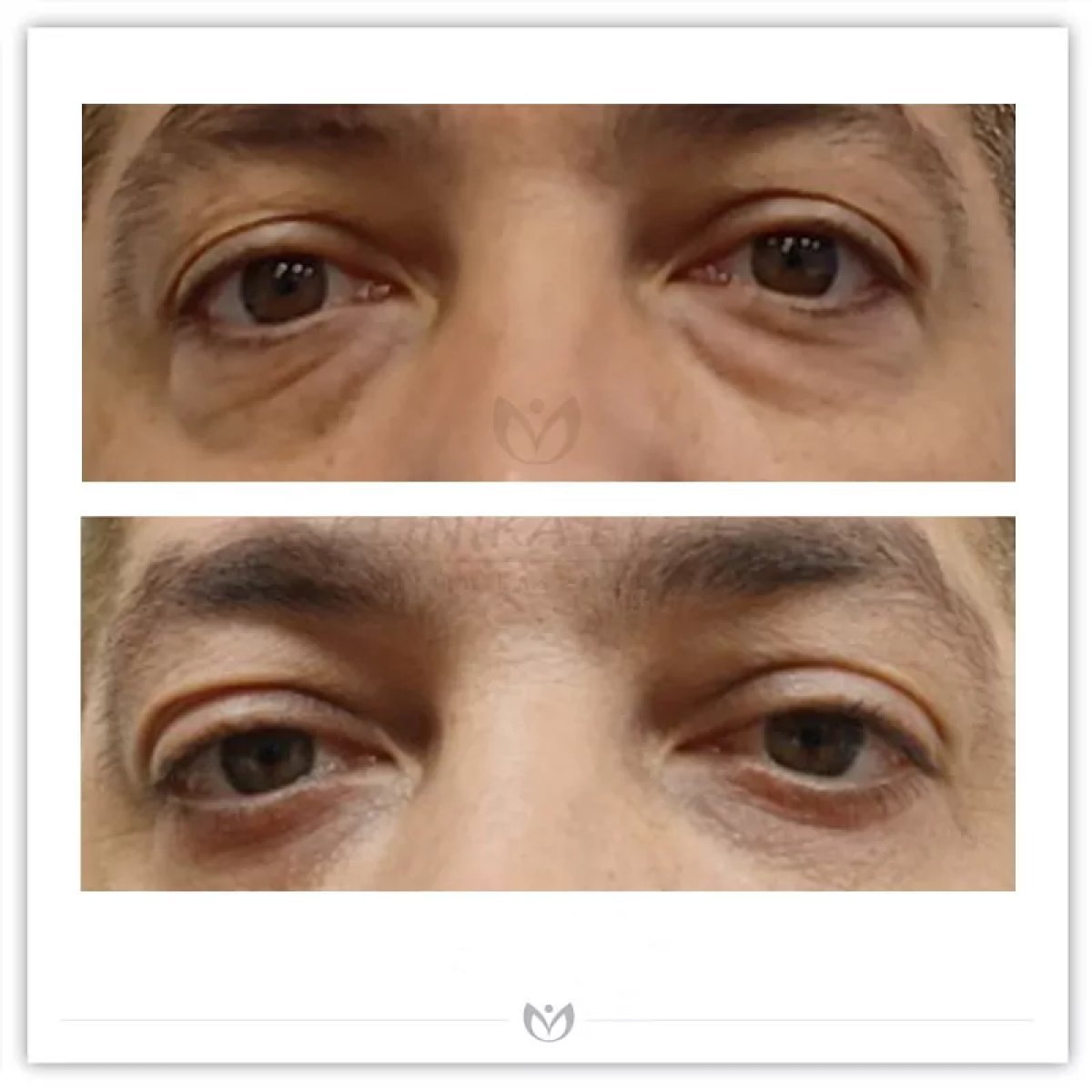 Before and after blepharoplasty results at Klinika Elite Centrum Laseroterapii, eyelid correction