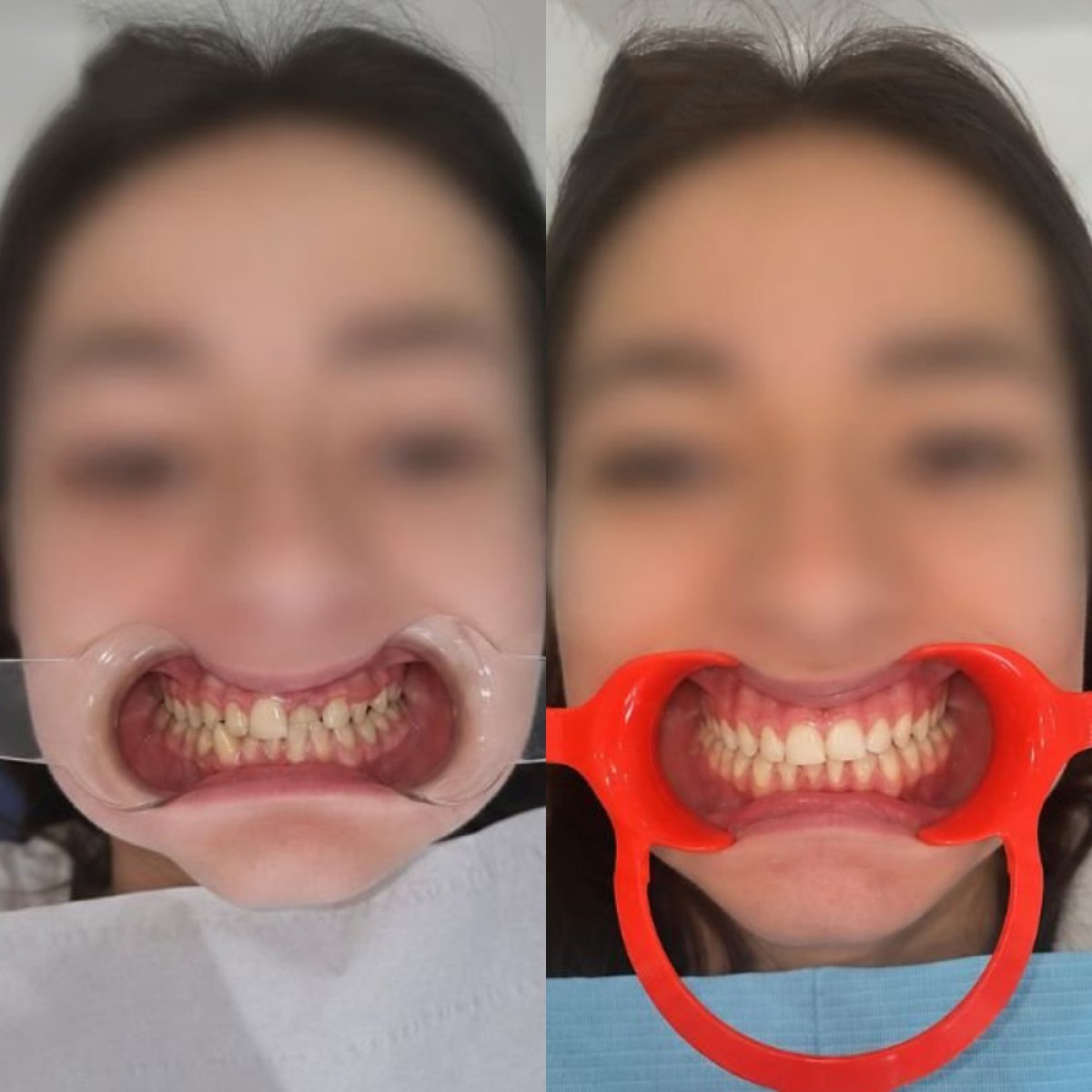Результаты до и после брекетов в Unident Clinic – выравнивание зубов и улыбки