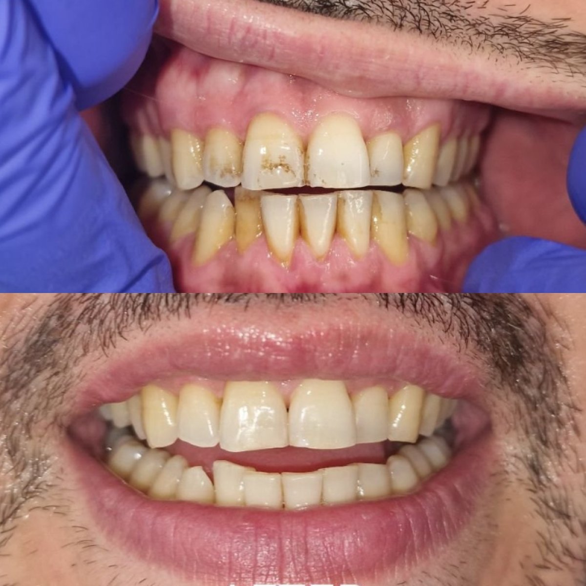 Résultats avant/après détartrage dentaire à Unident Clinic – dents visiblement plus blanches