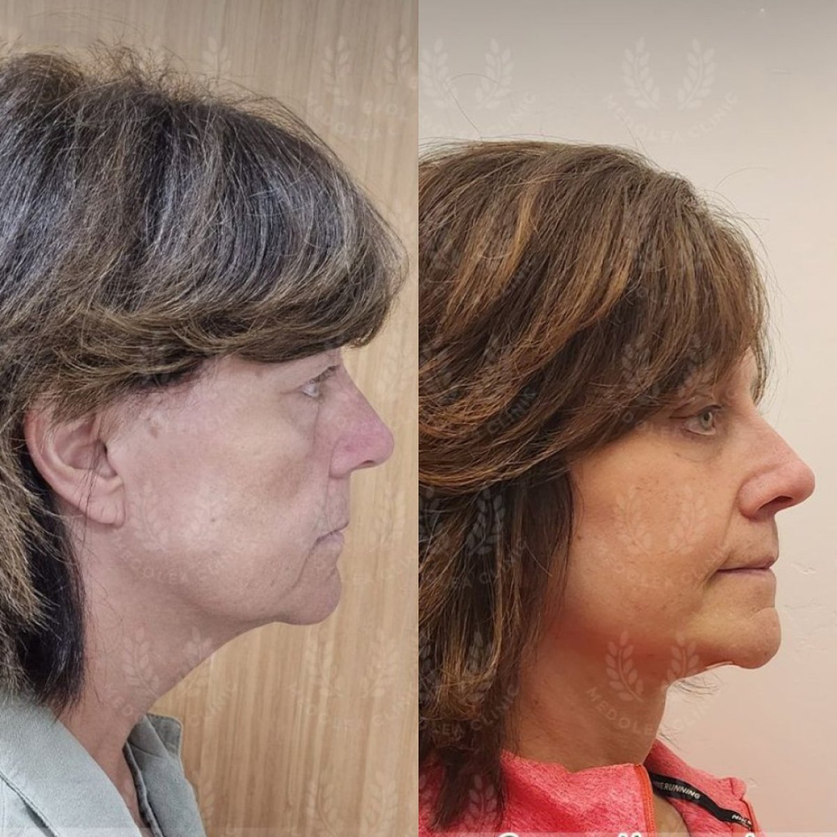 Resultados antes y después de deep plane facelift en Dr. Safa Manav Clinic, rejuvenecimiento facial
