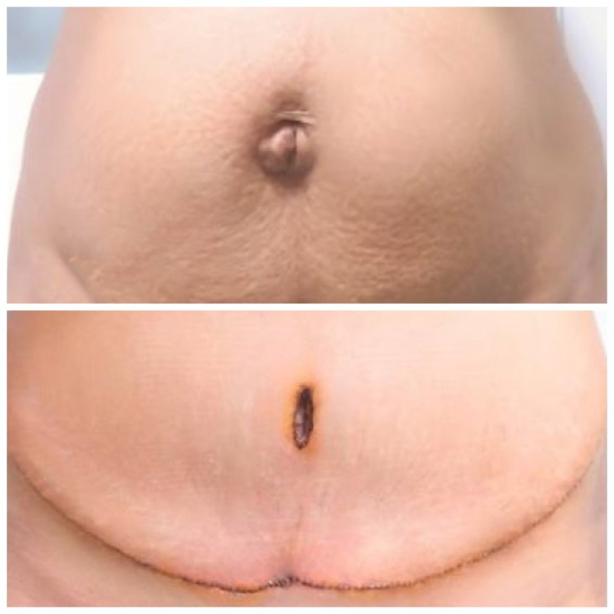 Resultados de abdominoplastia y liposucción antes y después en Somchai Clinic, abdomen mejorado