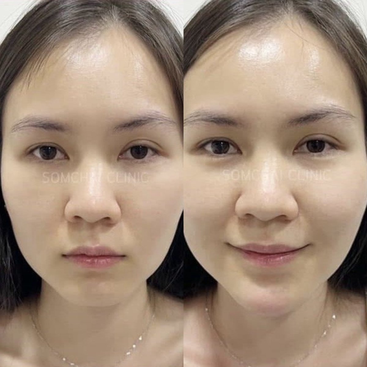 Before and after brow lift results at Somchai Clinic, visible eyebrow and forehead lift
