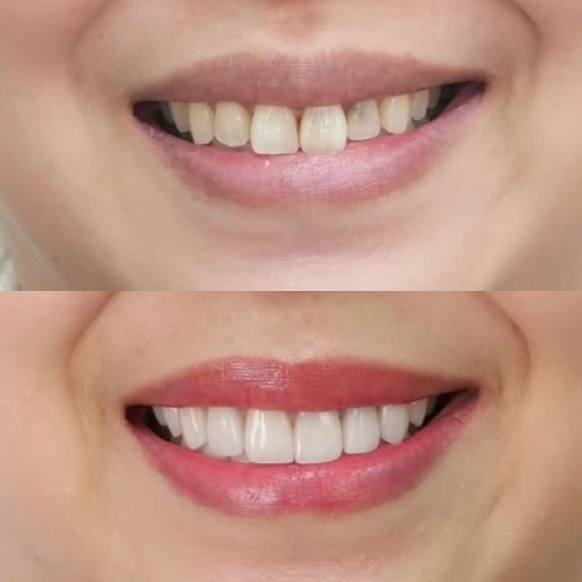 نتائج قبل وبعد الفينير في Dentist at home بانكوك – ابتسامة طبيعية محسنة