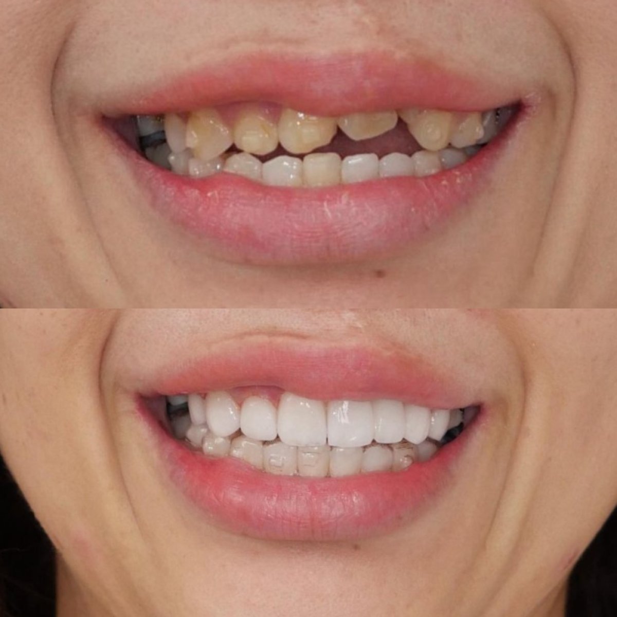 До и после установки виниров в Dentist at home, Бангкок – естественное преображение улыбки