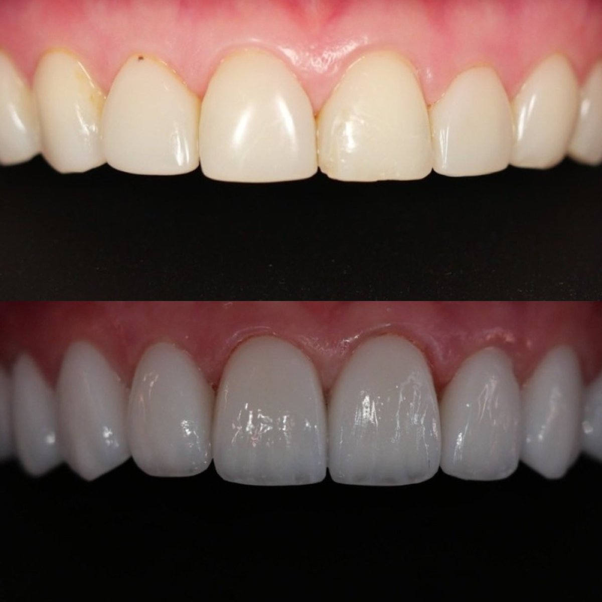 Avant-après facettes dentaires chez Dentist at home, Bangkok – sourire amélioré et dents blanches