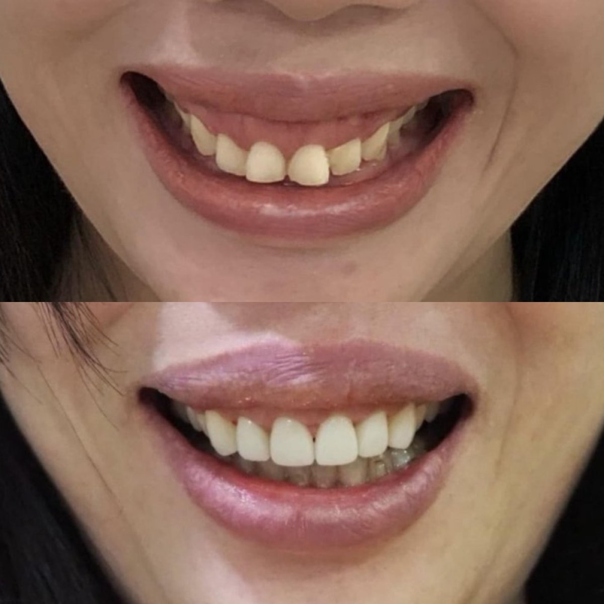 Before and after veneers at Dentist at home, Bangkok – smile makeover visible result
