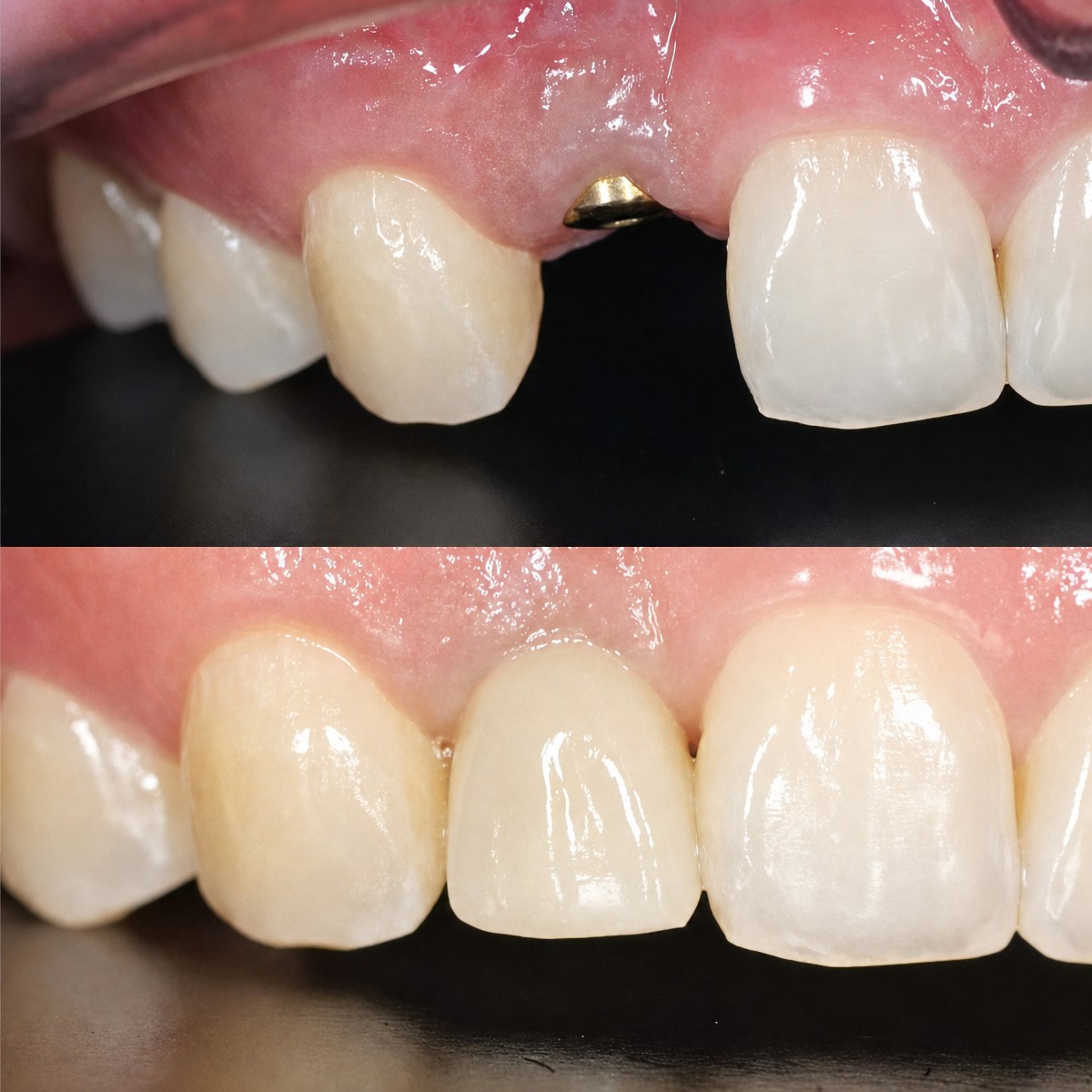 Результаты до и после имплантации зубов в Dentist at home, Бангкок – восстановлены передние зубы