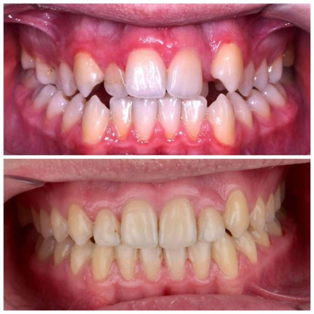 Before and after clear aligners at Smile Centrum – teeth alignment and bite correction result
