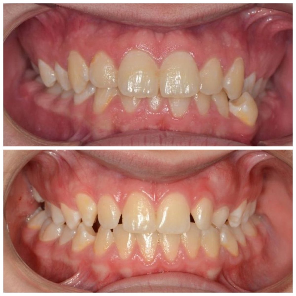 Before and after clear aligners result at Smile Centrum – straighter teeth and improved alignment
