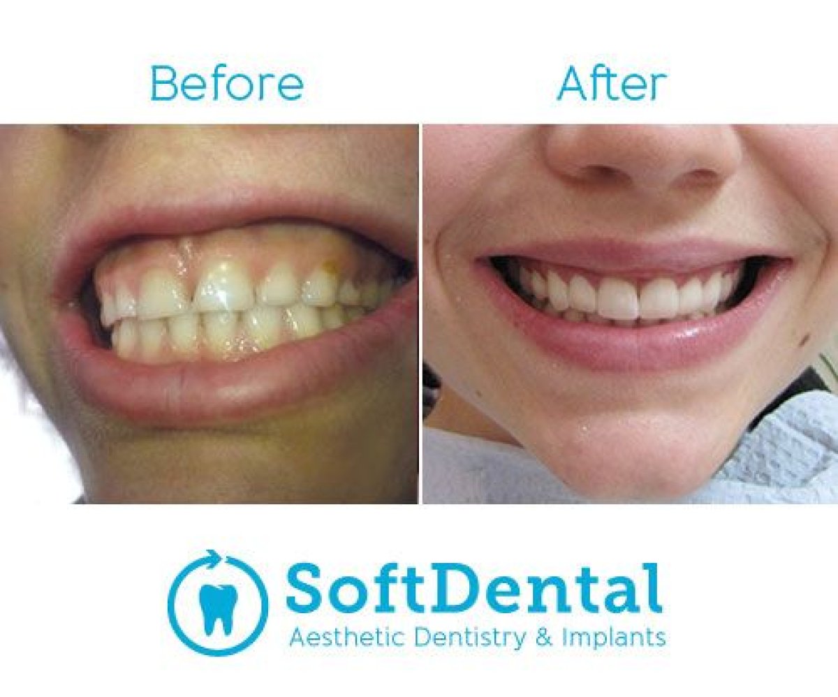 نتائج قبل وبعد الفينير في SoftDentalCare Clinic، ابتسامة طبيعية المظهر