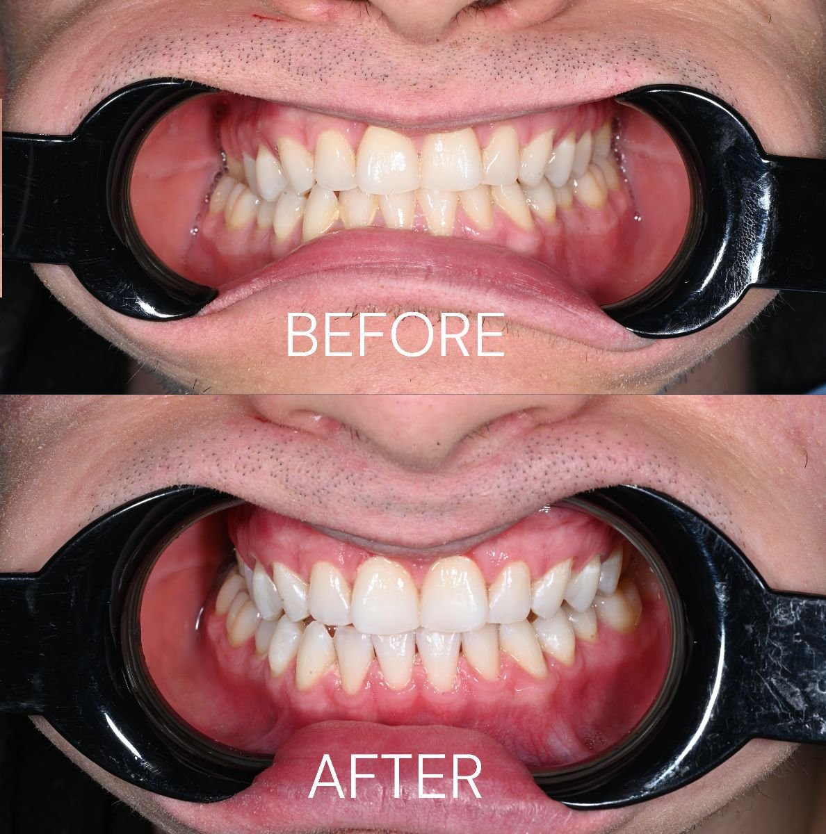 Before and after tooth whitening results at Unident Clinic – visibly brighter smile transformation