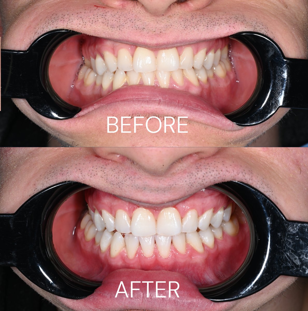 Before and after teeth cleaning (scaling) results at Unident Clinic – visibly whiter teeth