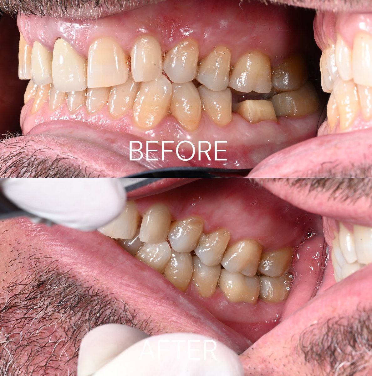 نتائج قبل وبعد تركيب تيجان الزركونيا في عيادة Unident – تحسين جمالية الابتسامة