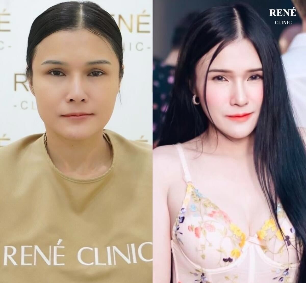 Resultados antes y después de botox para arrugas en RENÉ Clinic – rostro más suave y joven
