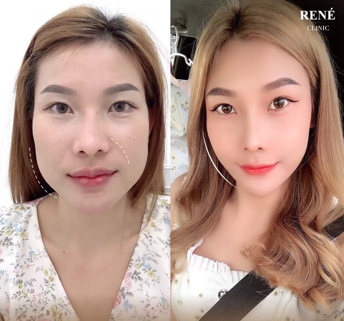 نتائج حقن البوتوكس قبل وبعد في René Clinic – ملامح وجه أكثر نعومة ورفعًا