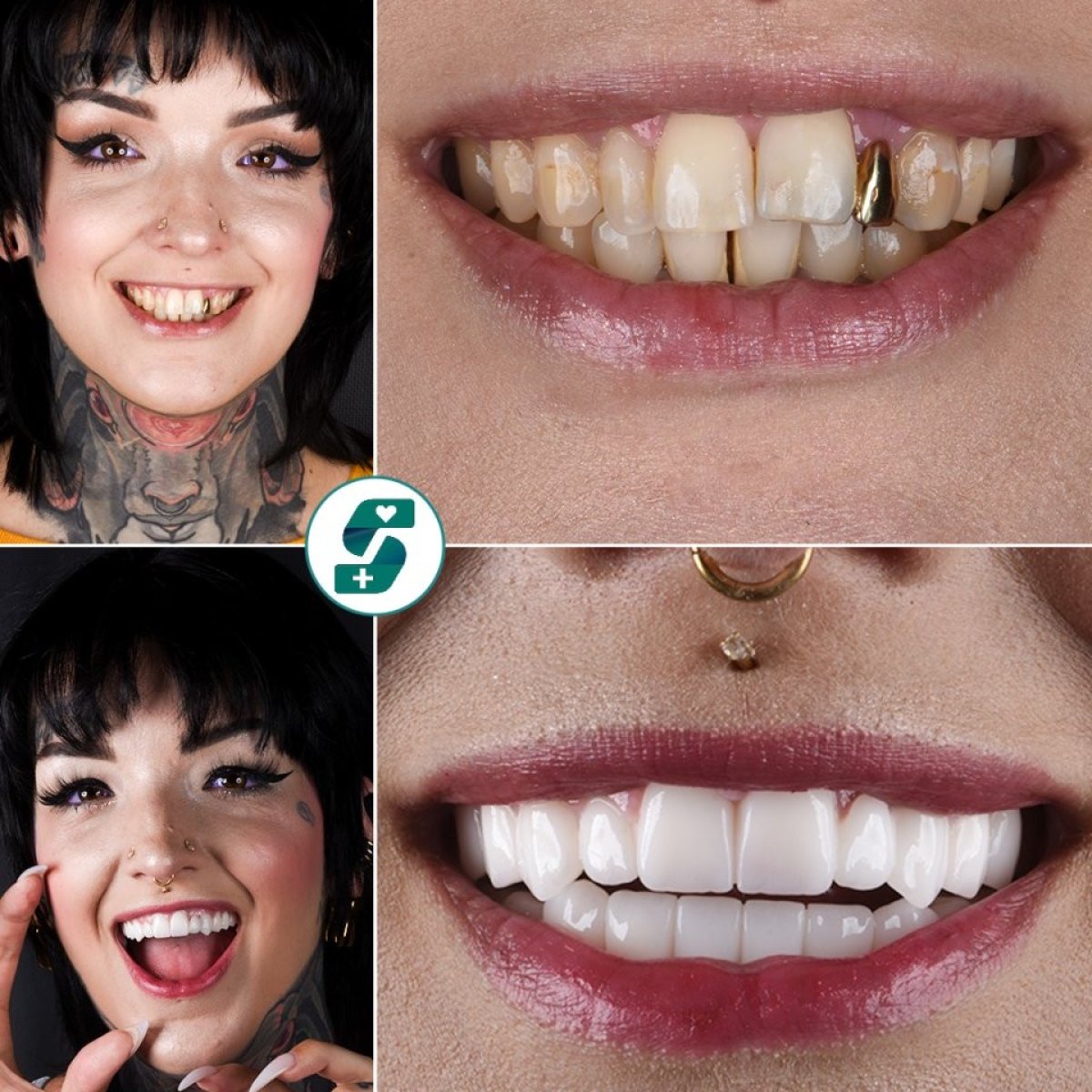 Hollywood Smile before and after results at Soraca Med – dental veneers for a bright smile