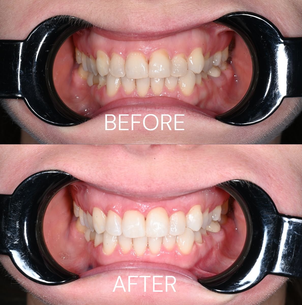 Resultados de blanqueamiento dental antes y después en Unident Clinic: sonrisa más brillante