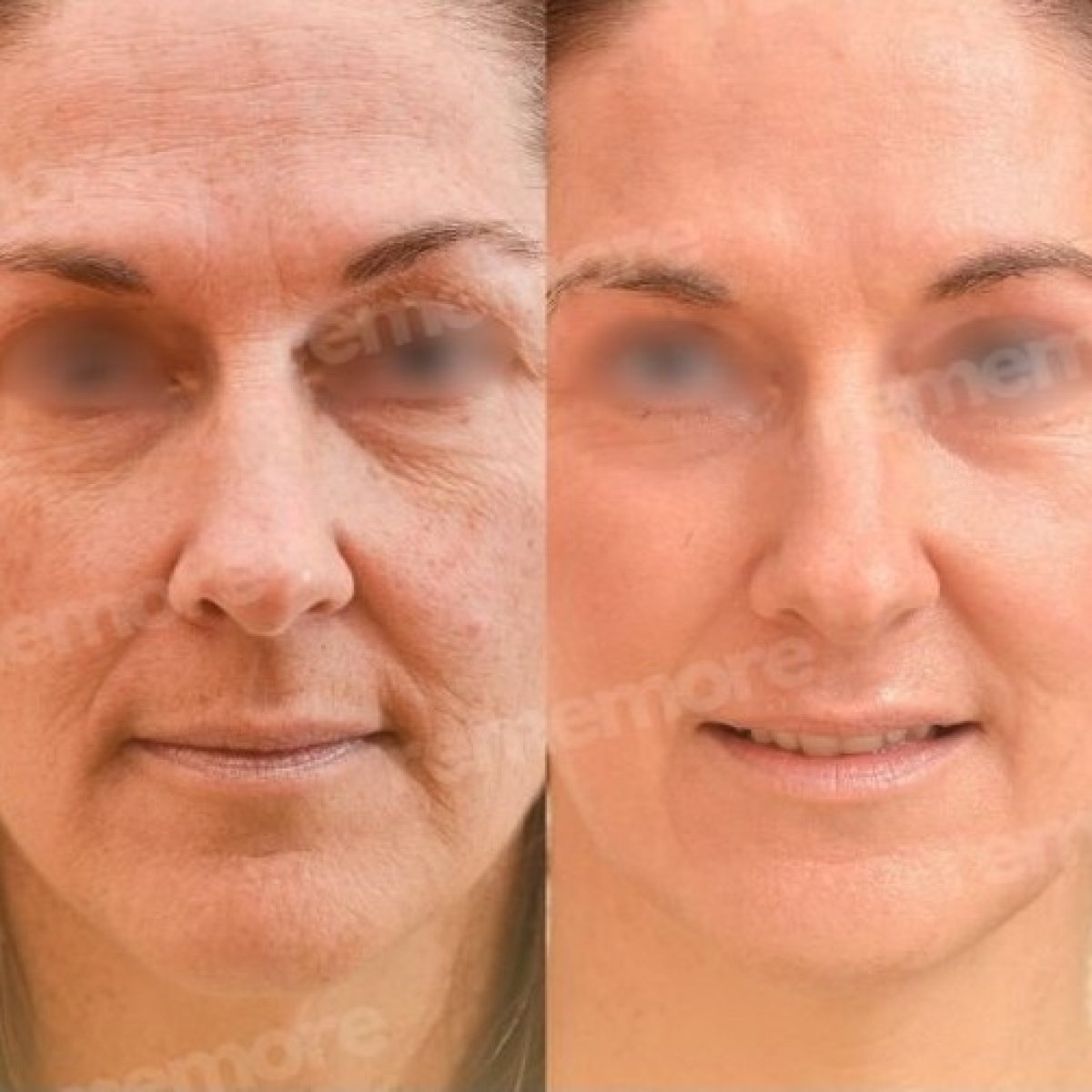 Before and after brow lift results at Memorial Şişli Hospital, visible forehead rejuvenation