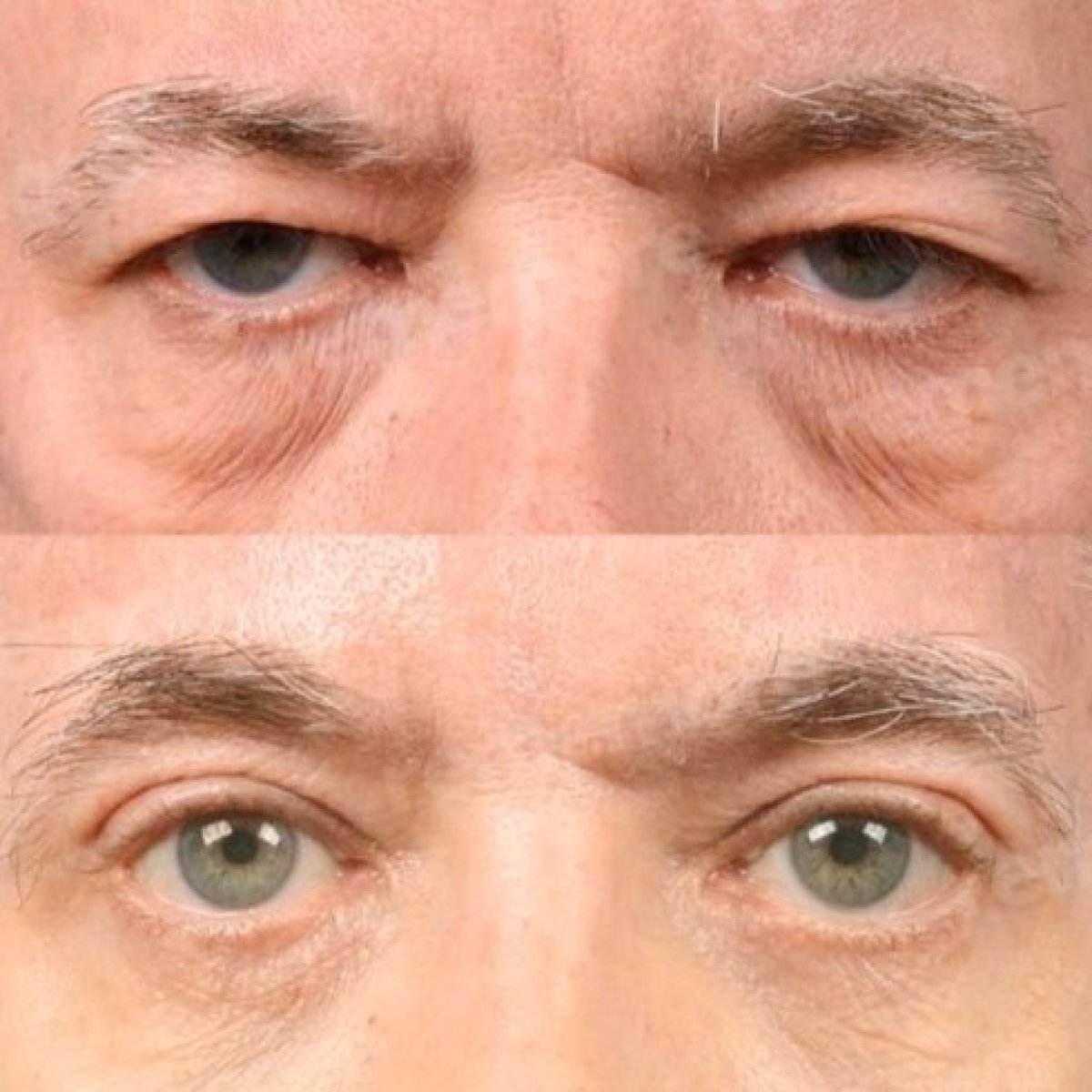 Before and after blepharoplasty results at Memorial Göztepe Hospital, eyelid correction