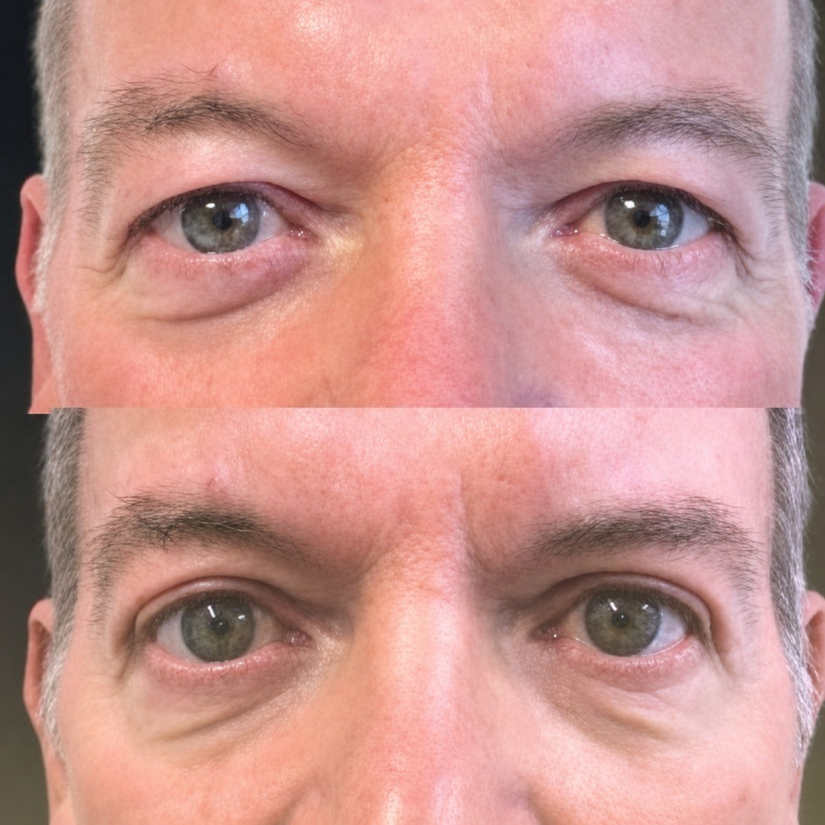 Before and after blepharoplasty results at Memorial Göztepe Hospital, eyelid correction