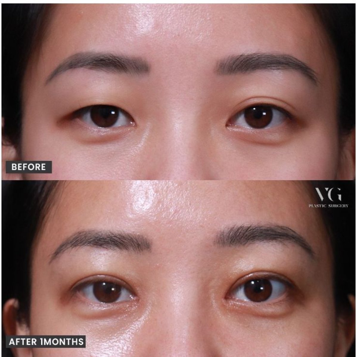 نتائج شد الجفن العلوي قبل وبعد في VG Plastic Surgery، تحسين مظهر الجفون