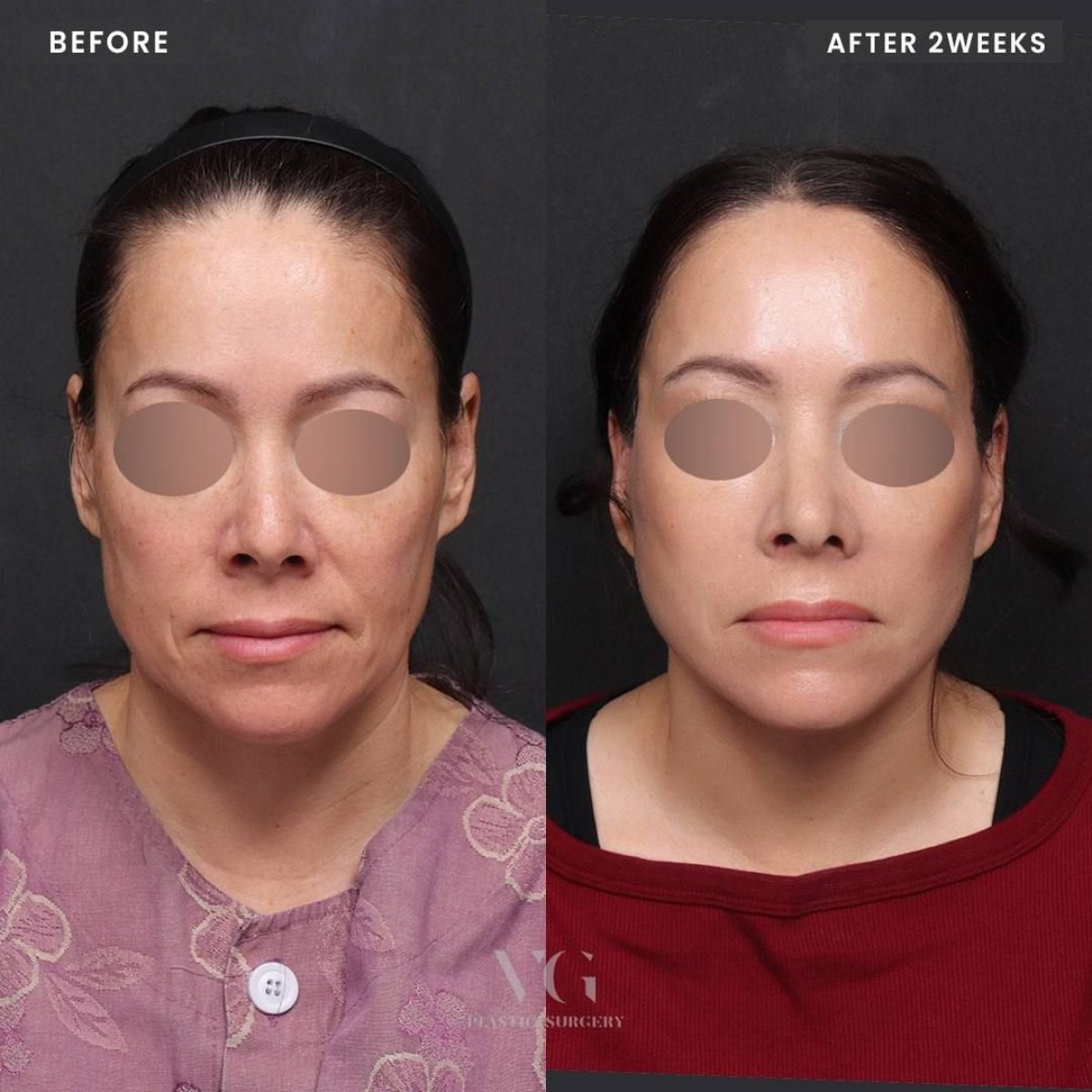 Resultados de lifting facial antes y después en VG Plastic Surgery, rejuvenecimiento facial a 2 semanas