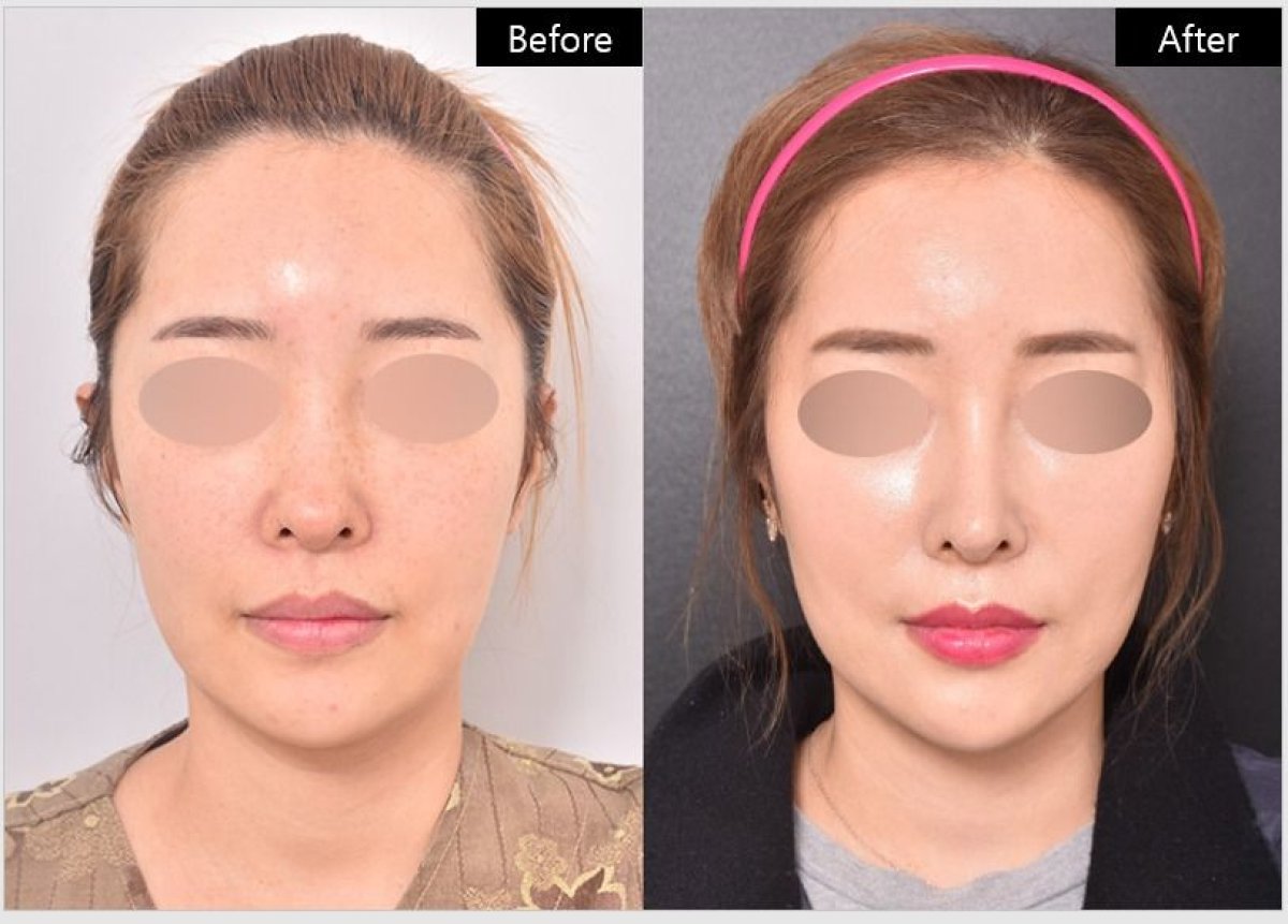 نتائج شد الوجه بالخيوط قبل وبعد في VG Plastic Surgery – تحسين واضح لتحديد الوجه