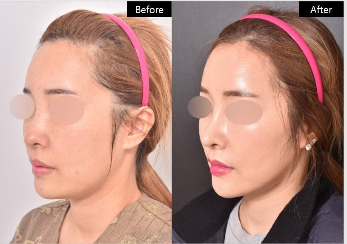 نتيجة شد الوجه بالخيوط قبل وبعد في VG Plastic Surgery – تحسين واضح لتحديد الوجه