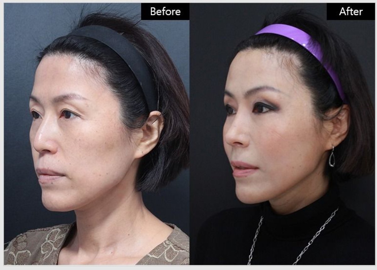 نتائج شد الوجه بالخيوط قبل وبعد في VG Plastic Surgery – تحسين واضح لتحديد الوجه