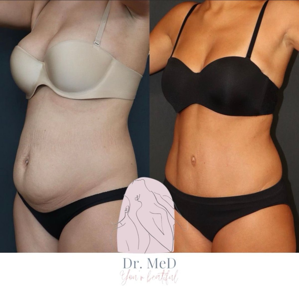 Résultats avant/après liposuccion chez Dr. MED – amélioration visible du ventre