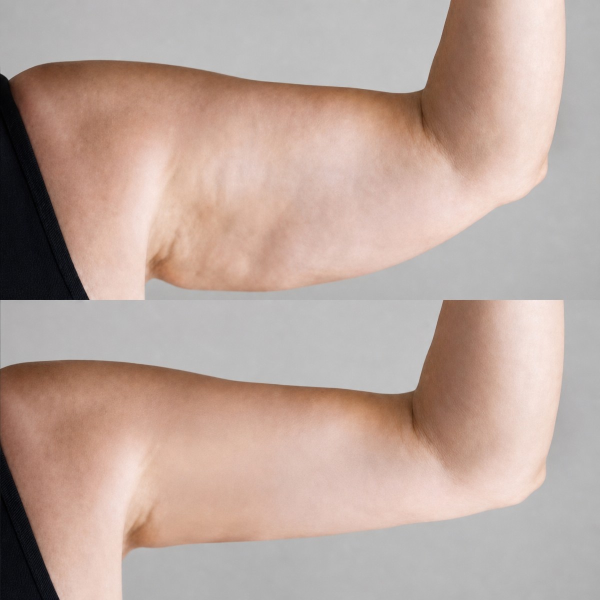 Before and after arm liposuction results at Hisar Hospital Intercontinental, improved contour