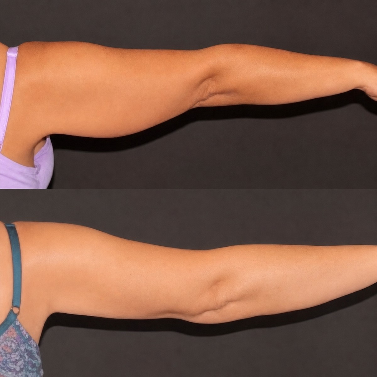 Before and after upper arm liposuction results at Hisar Hospital Intercontinental, slimmer arms